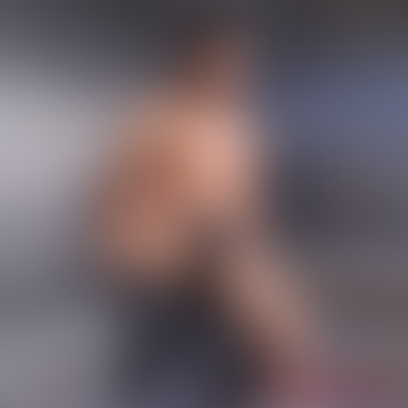 Cone anal para uma dilatação anal extrema - 1